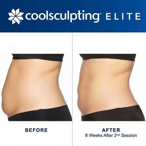 CoolSculpting Elite Before and After